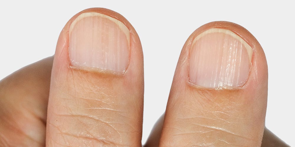 Ridges In Nails Causes Treatments And Prevention