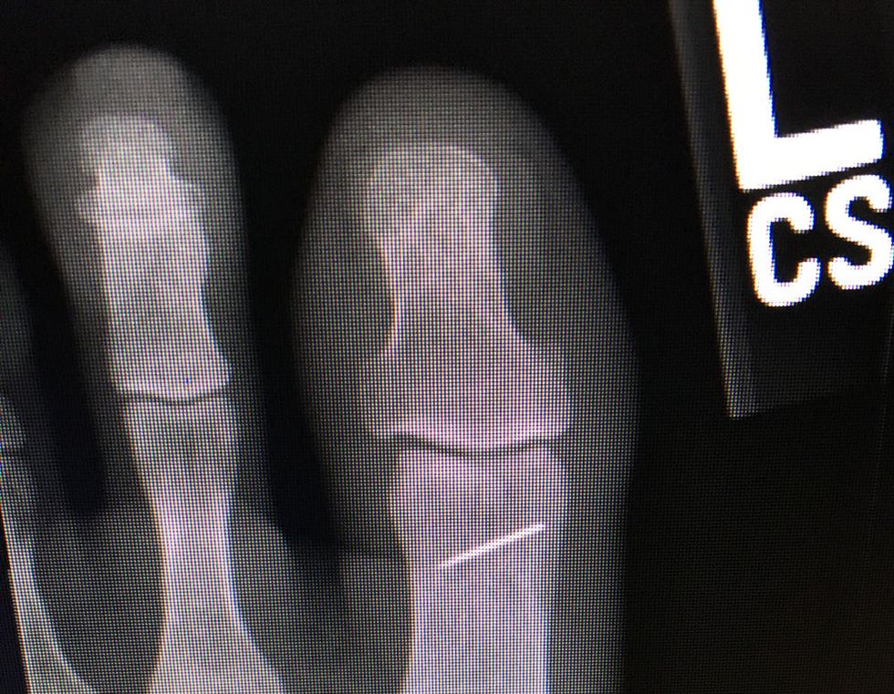 An x-ray of Paige's foot, showing the broken needle