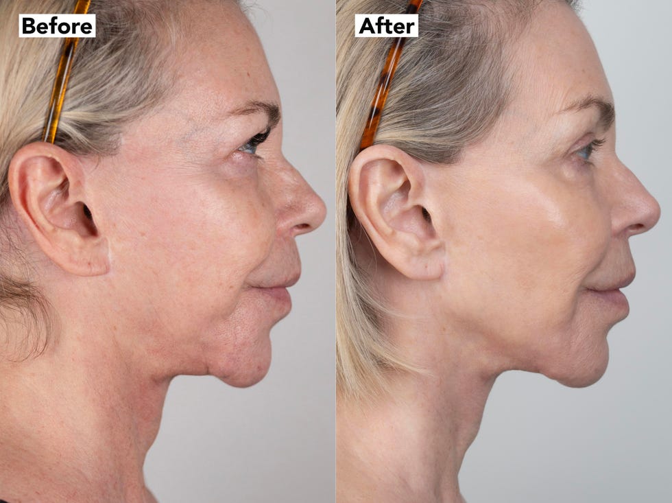 leslie ash 10 years younger facelift