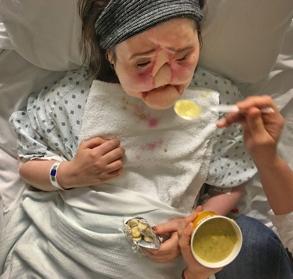 9 maanden en 21 dagen voor Katies transplantatieKatie krijgt soep als lunch Met haar beperkte zicht had ze moeite haar mond te vinden Op deze dag mocht ze geen vast voedsel eten vanwege een recente operatie