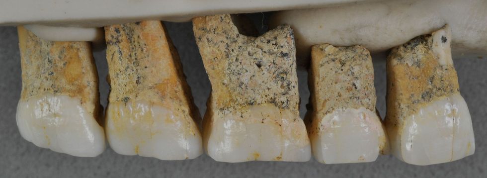 Vijf van de zeven tanden die worden toegeschreven aan Homo luzonensis De tanden zijn klein en hebben relatief simpele vormen maar een van de kiezen heeft drie wortels wat niet vaak voorkomt bij moderne mensen
