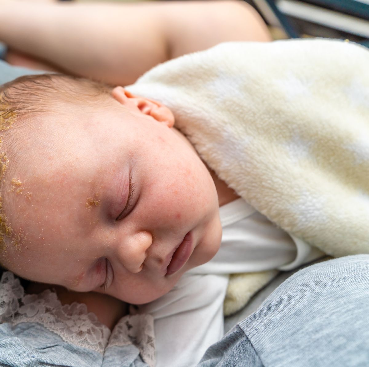 Qué es y cómo se trata la costra láctea en los bebés, Estilo de Vida  Madres
