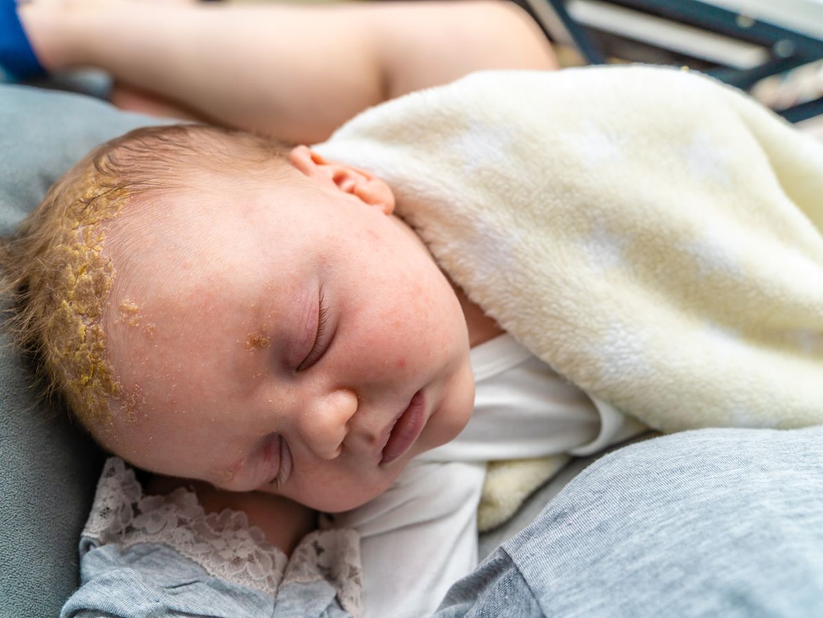 La costra láctea del bebé: causas y tratamiento 