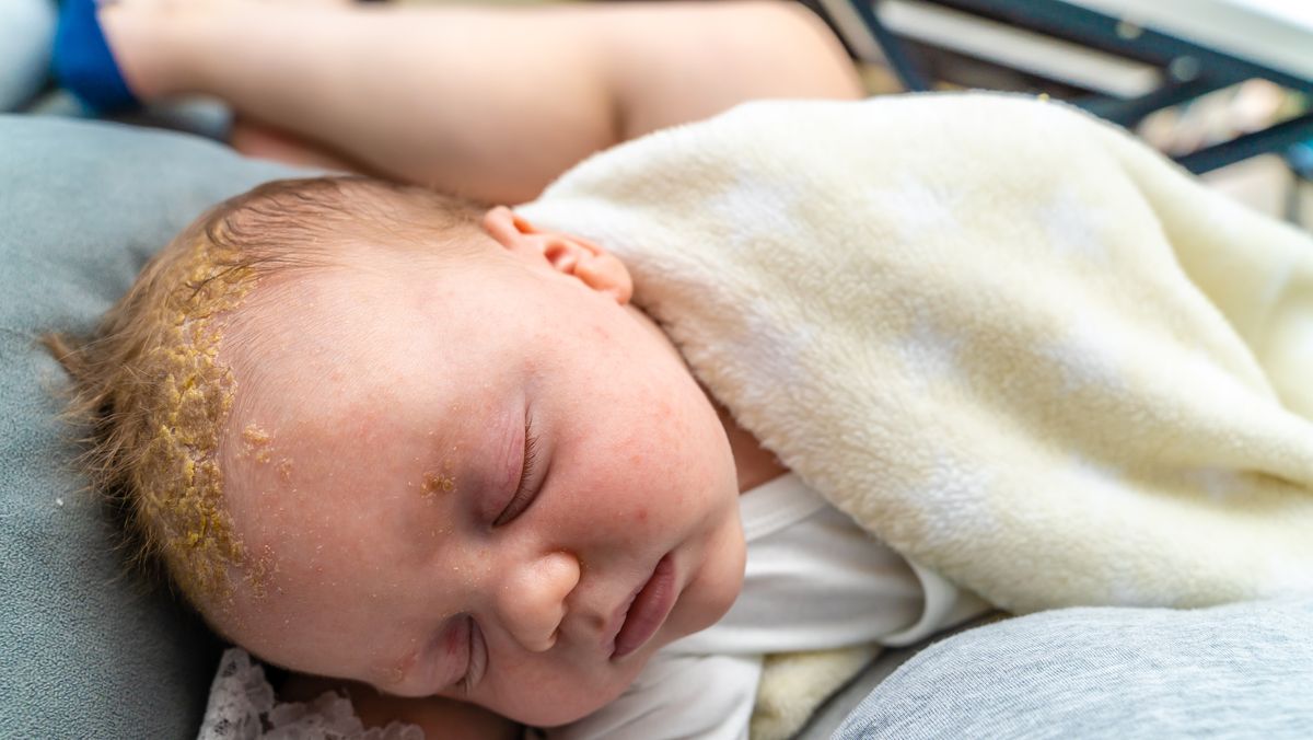 Qué es la costra láctea y cómo podés aliviar a tu bebé?