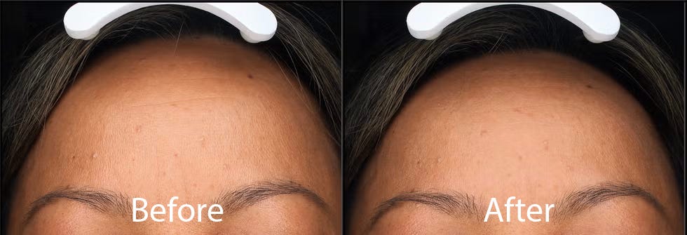 comparison of skin appearance before and after treatment on a forehead