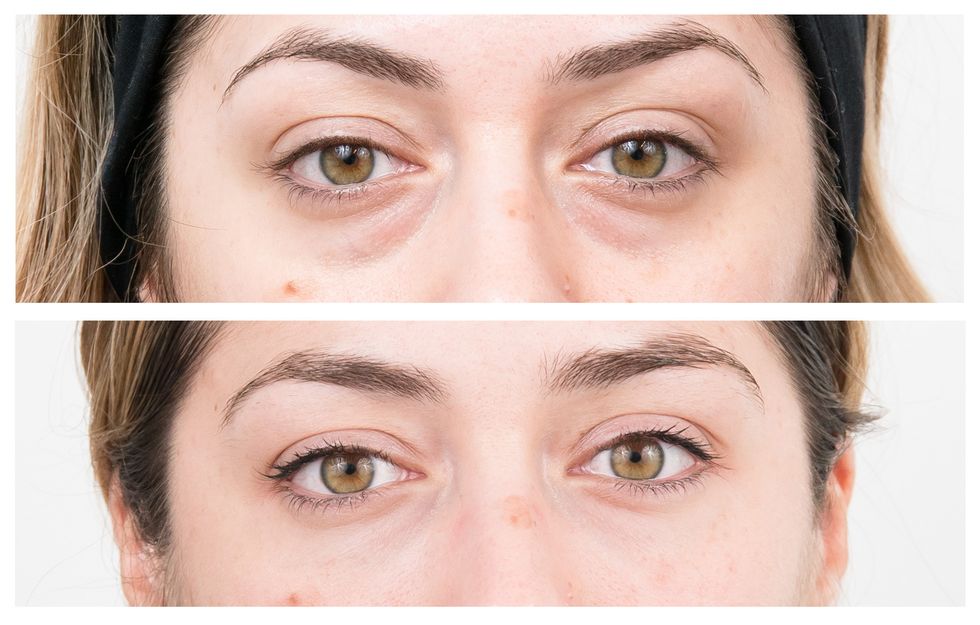 Everything you need to know about non-surgical eye bag removal