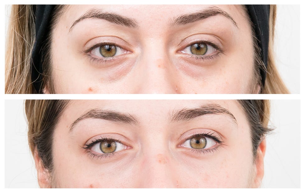 Non-surgical eye bag removal - tear trough filler treatment