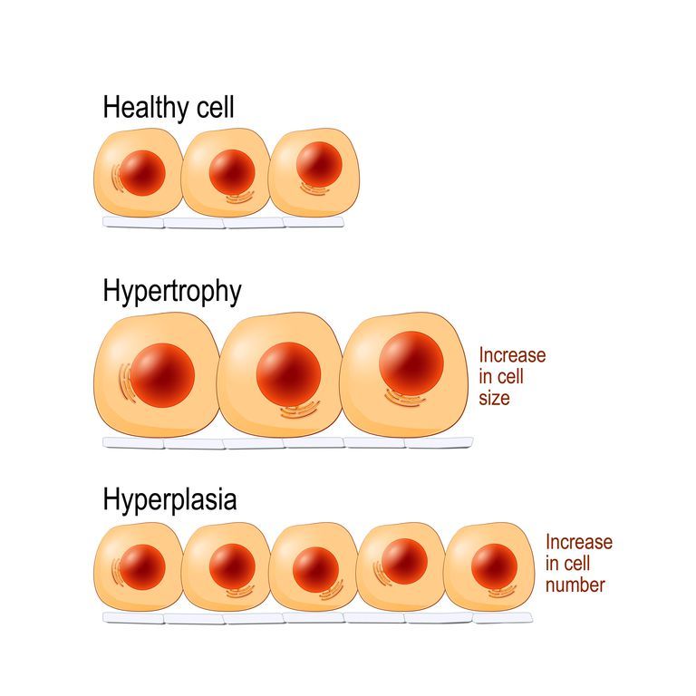 Normal cells, hypertrophy, and hyperplasia