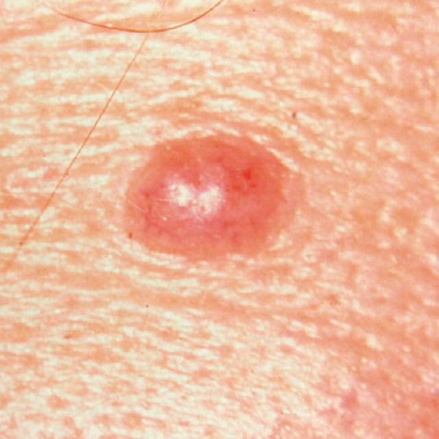 Is It Just A Mole—Or Something Worse? | Prevention