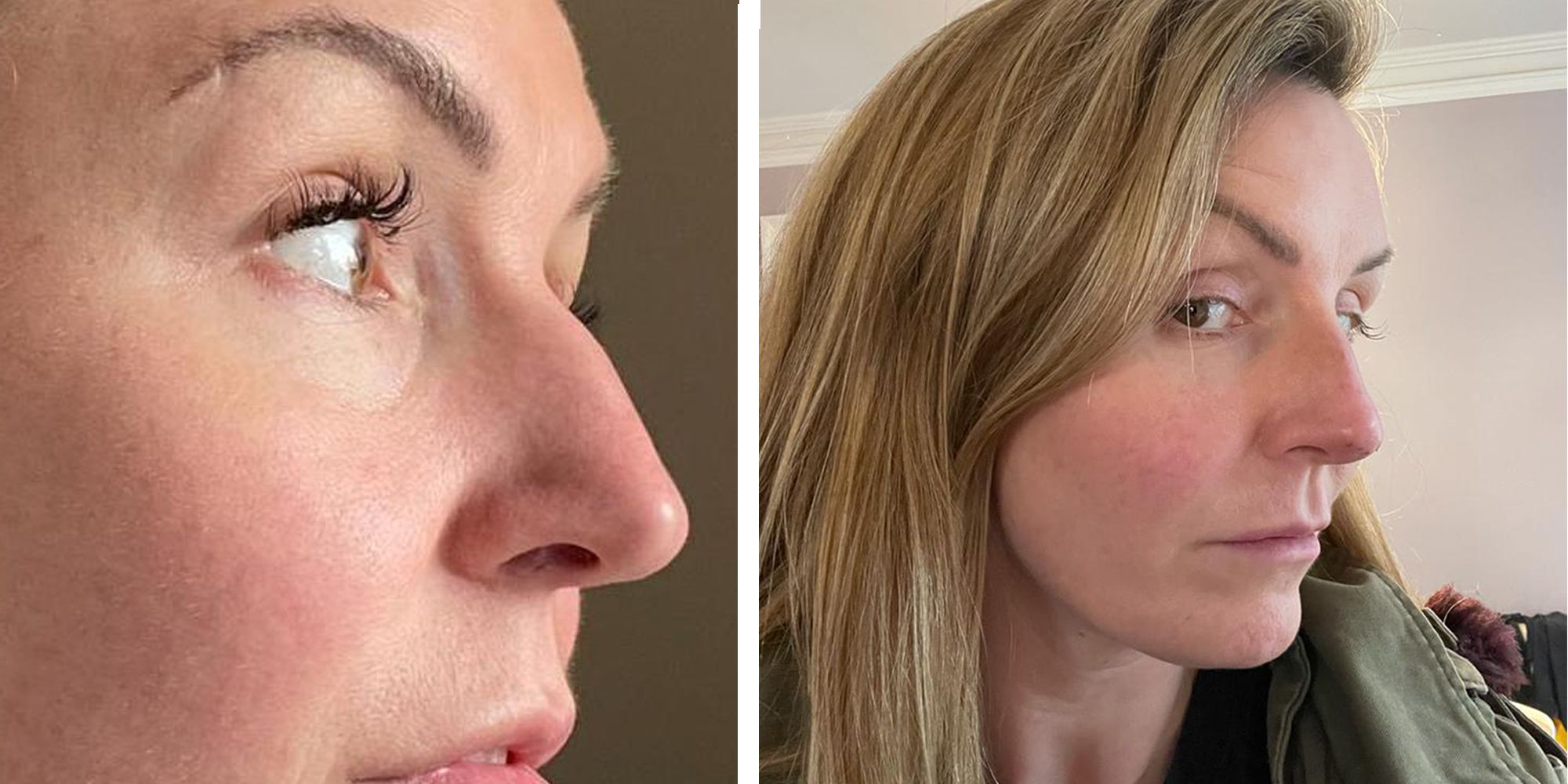 How to Make Your Nose Smaller Without Surgery?
