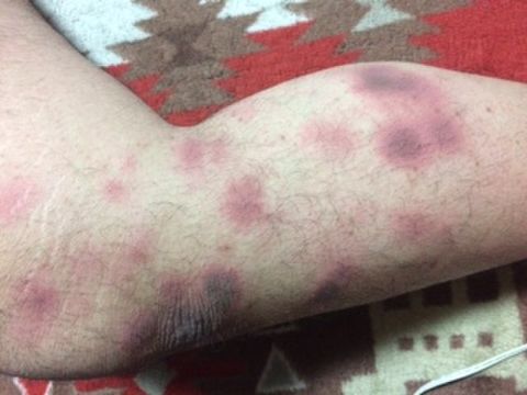nummular eczema on leg