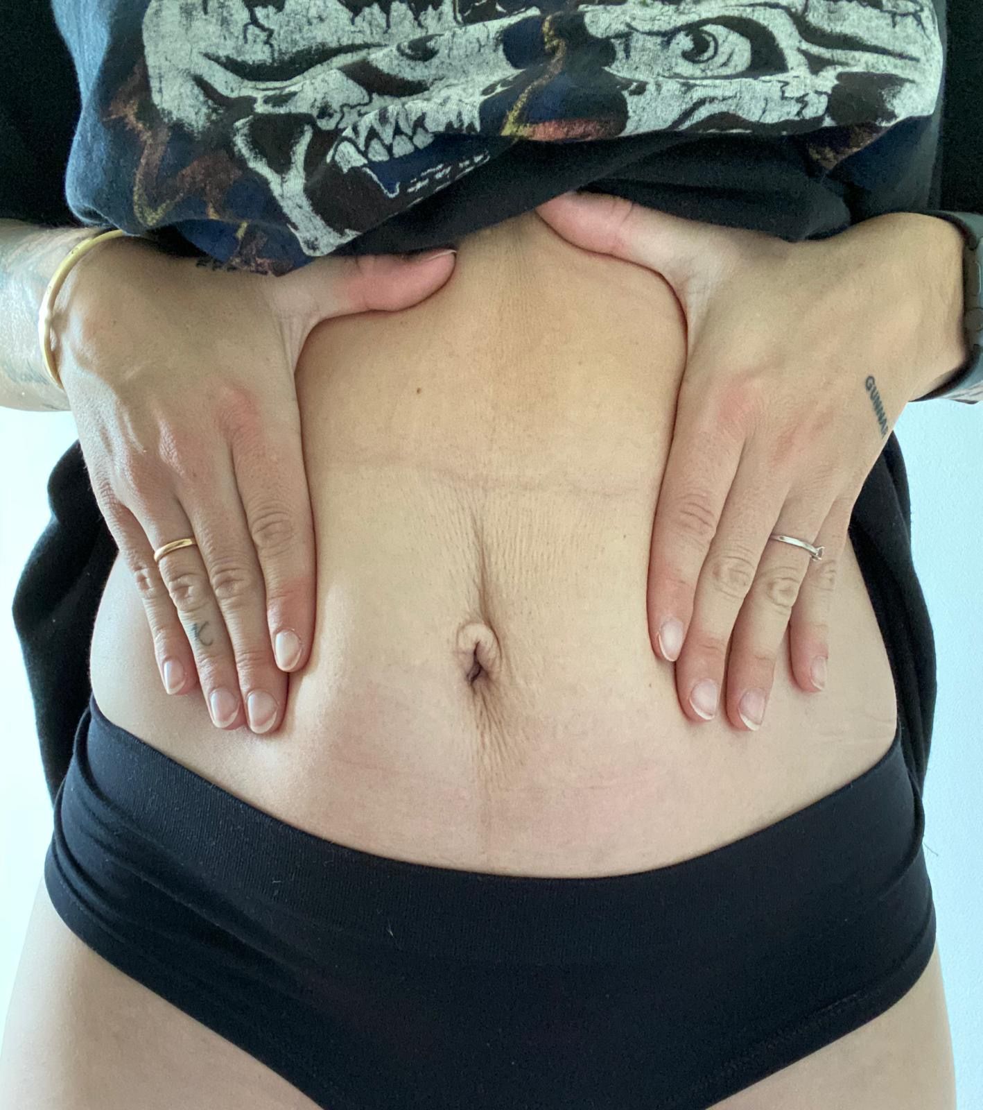 Post-Pregnancy Skin: 'How I Learnt to Love My Tummy