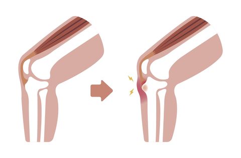 knee pain osgood schlatter