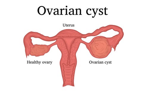 ovarian cyst spotting between periods