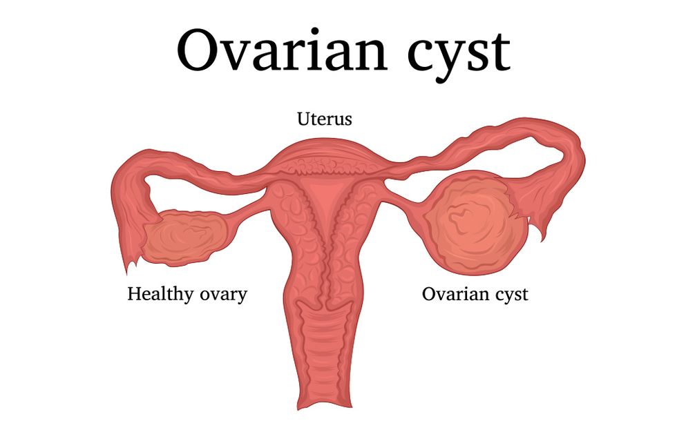 ​ovarian cyst symptoms