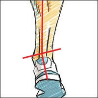 media overpronation, explained