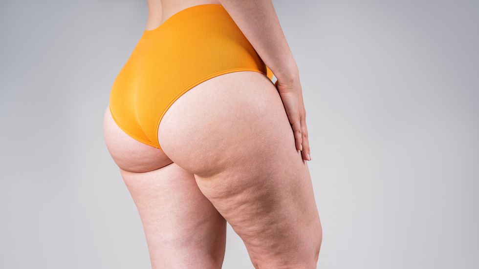 how to get rid of cellulite