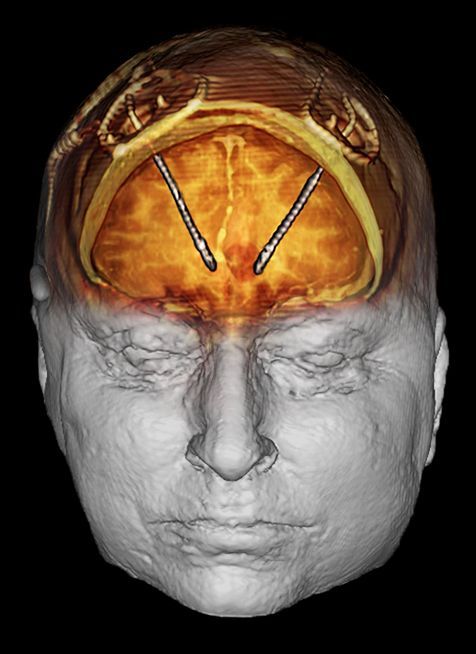 Bij diepe hersenstimulatie werden twee microelektroden in de hersenen van Grubb gemplanteerd