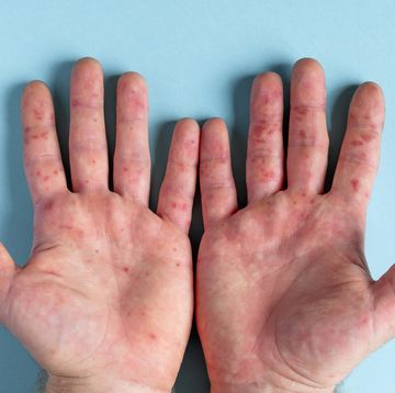 rash on hands