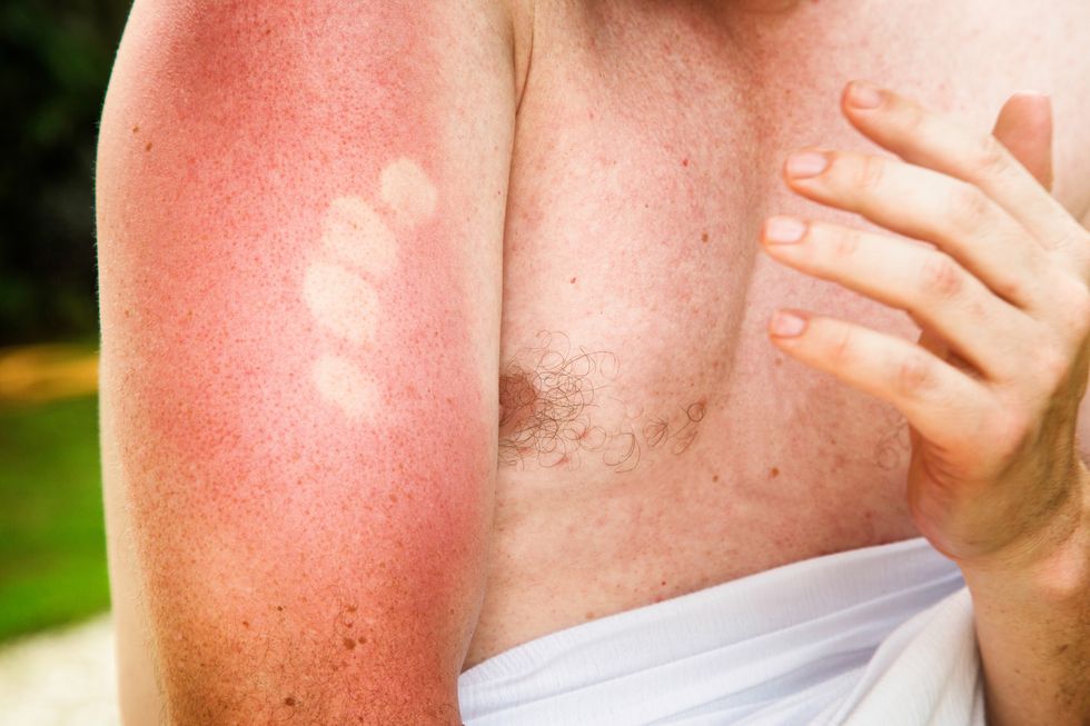 painful sunburn marks on upper male arm