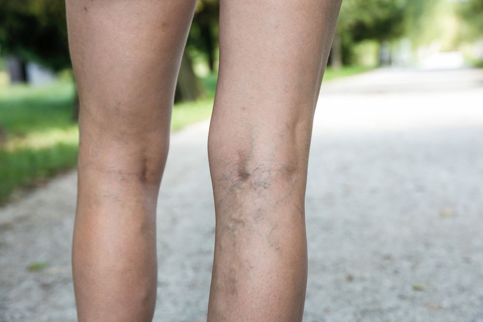 painful varicose and spider veins on womans legs