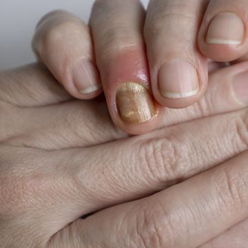 paronychia disease of the fingernail