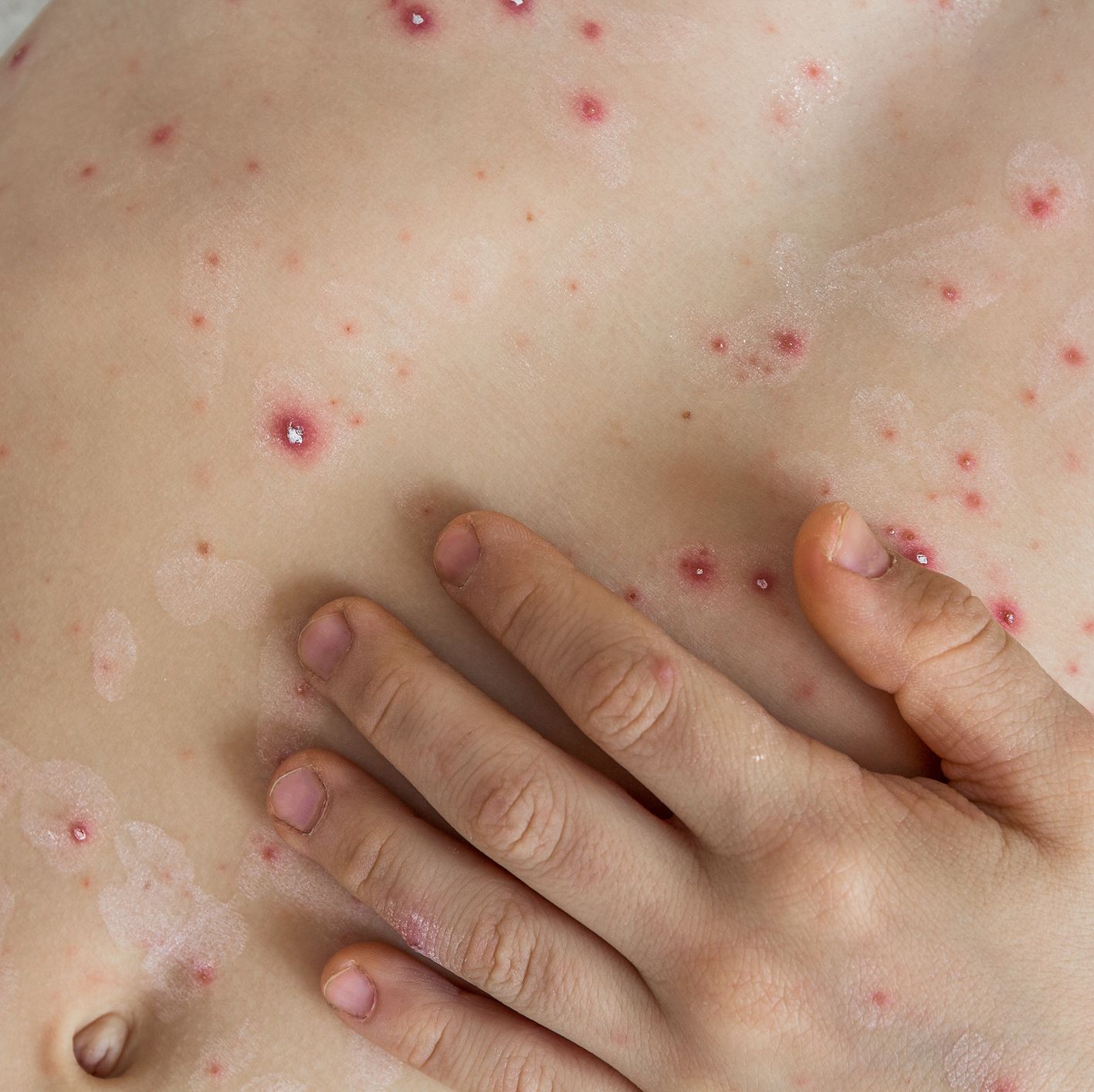 itchy skin allergy medicine