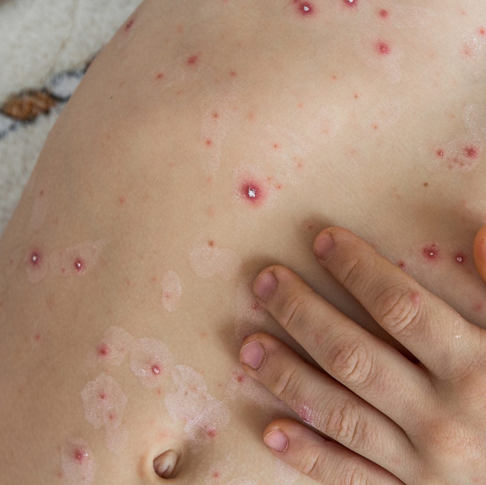 part of child's body with chickenpox bubbles