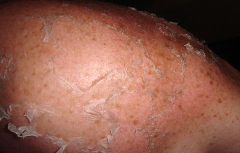 peeling skin