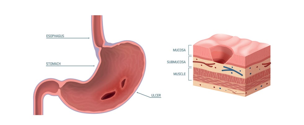 Peptic ulcer nausea