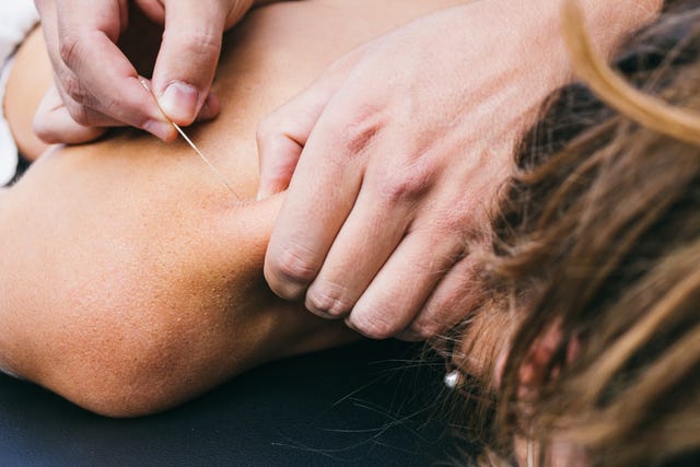 What is Electro-Dry Needling and how can it help with chronic pain and  injury treatment?