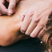 dry needling injury treatment