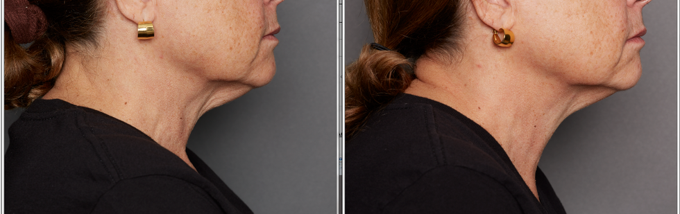 a side by side photo of a woman's neck before and after our neck cream test
