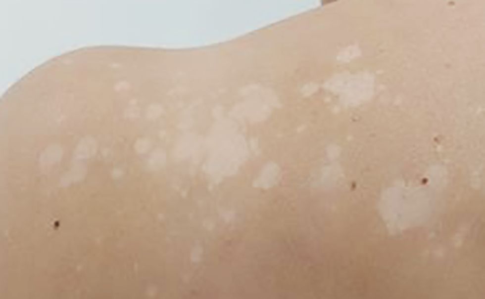 What is pityriasis versicolor? The white patches you might get on your skin