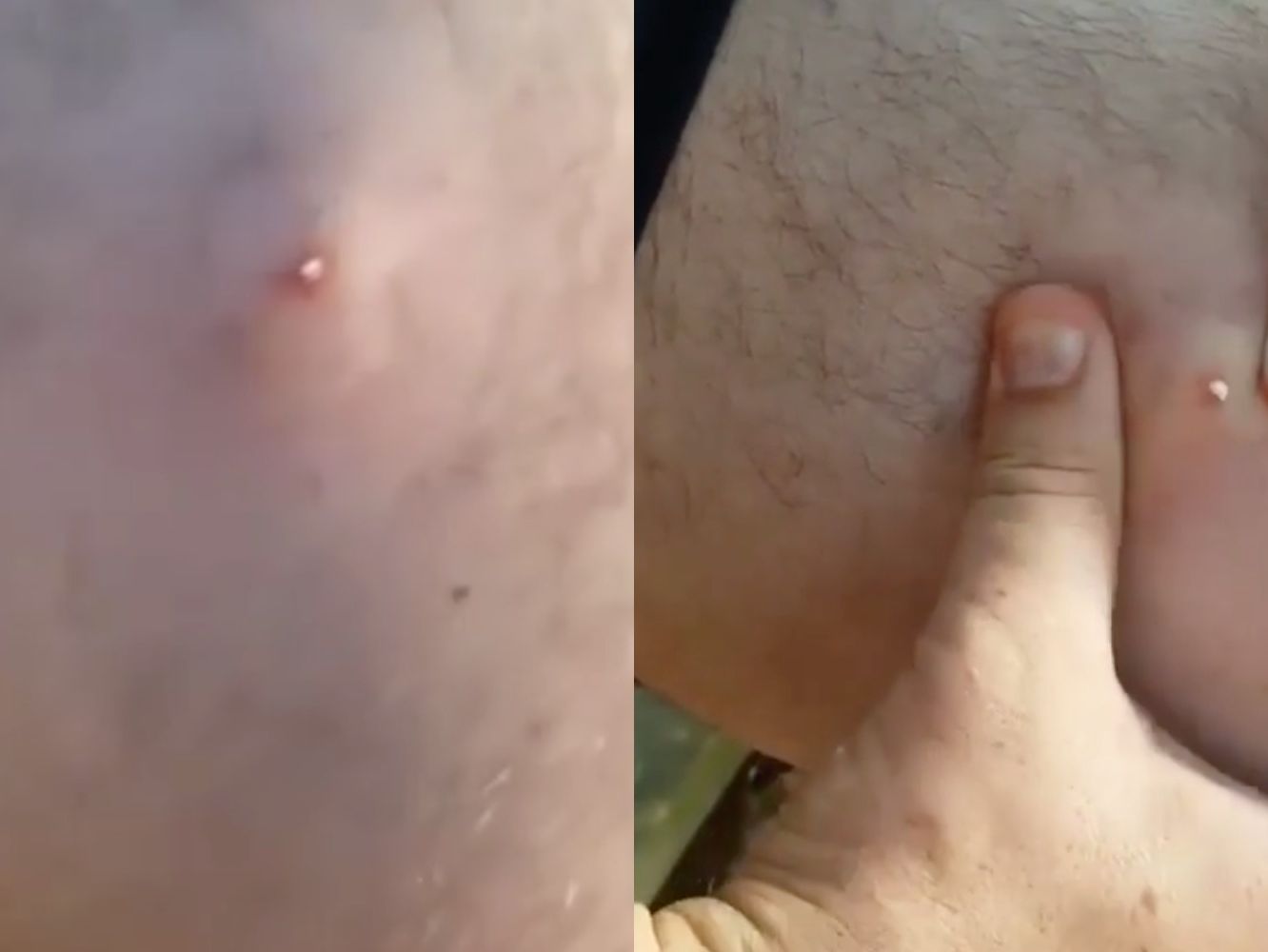 popping zits on back
