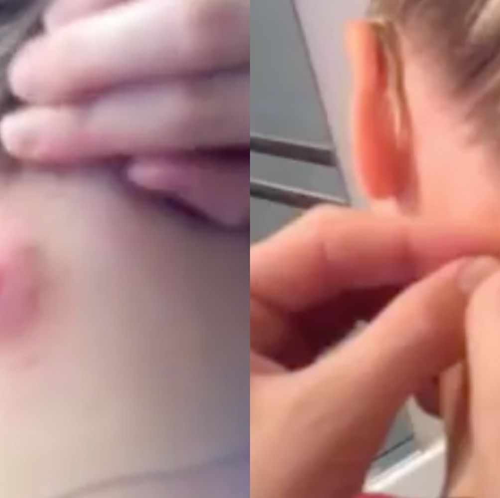 This Pimple Video Great for Poppers