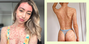2017年、「乾癬（かんせん）」と診断されたイギリス・エセックス出身のクレアさん（25歳）。何年も肌を隠して過ごしてきた彼女は、2021年のはじめに自身の病気のことを知ってほしいとinstagramのアカウントを立ち上げ、体験談を発信している。