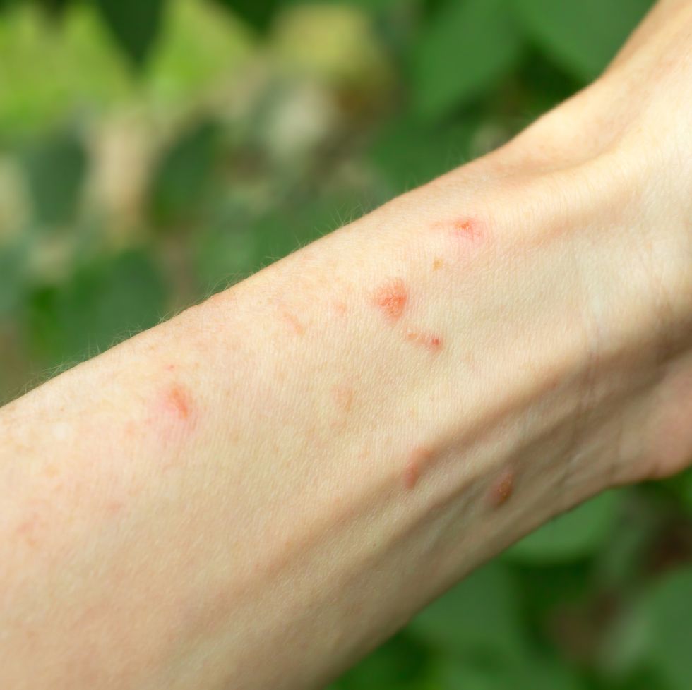 30 Common Skin Rash Pictures - How to ID Skin Rash Symptoms