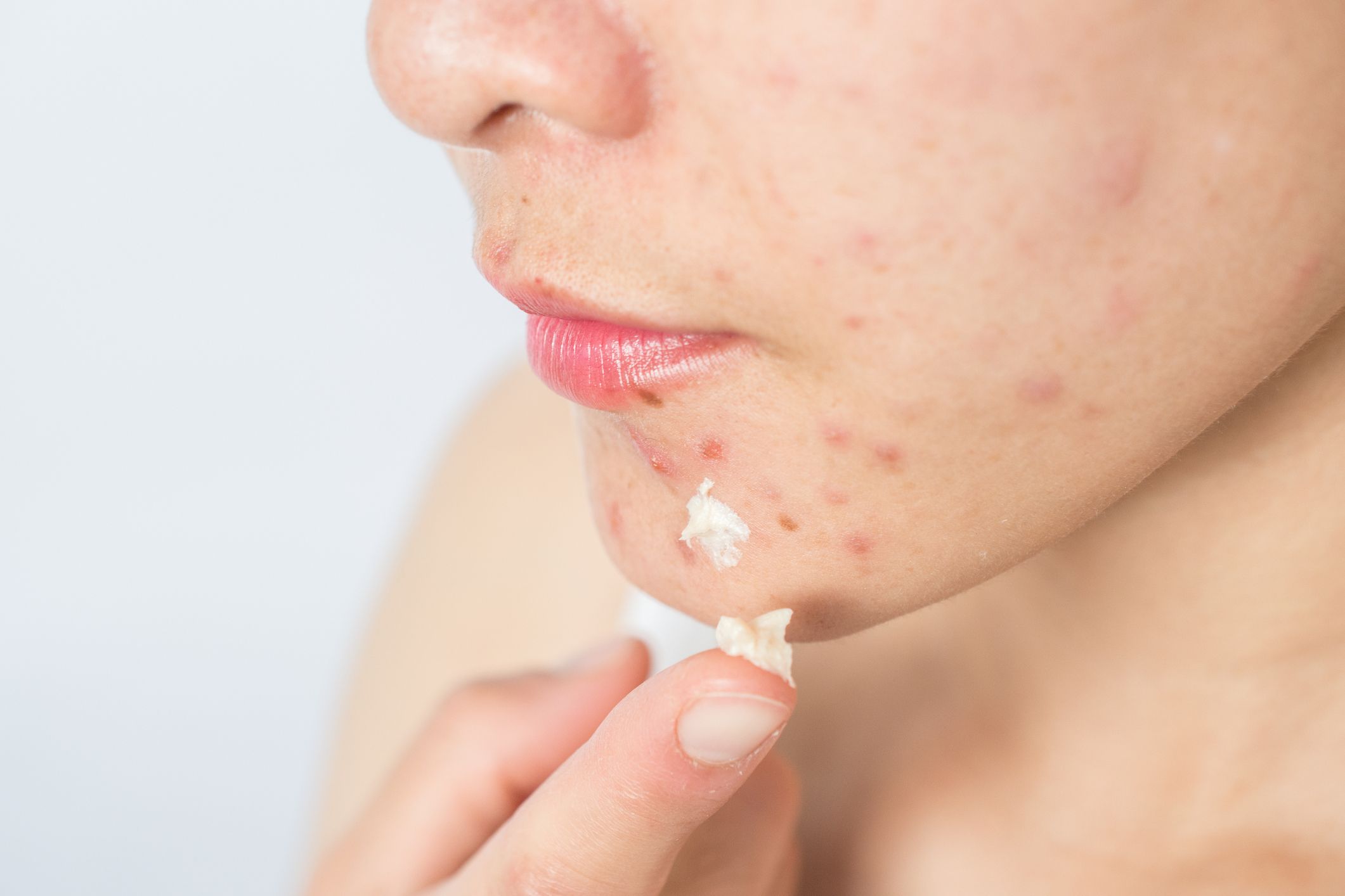 25 Questions You Need To Ask About Acne