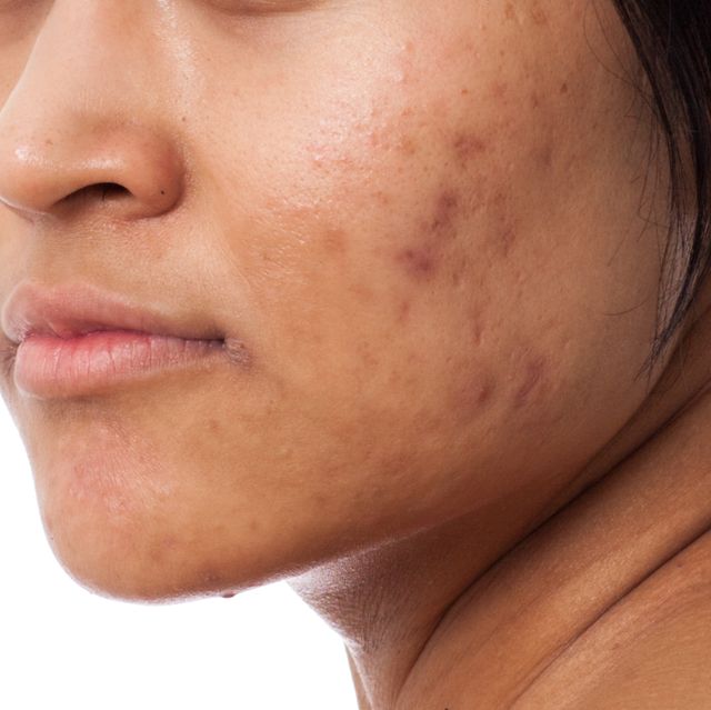 portrait of young woman with acne and scars