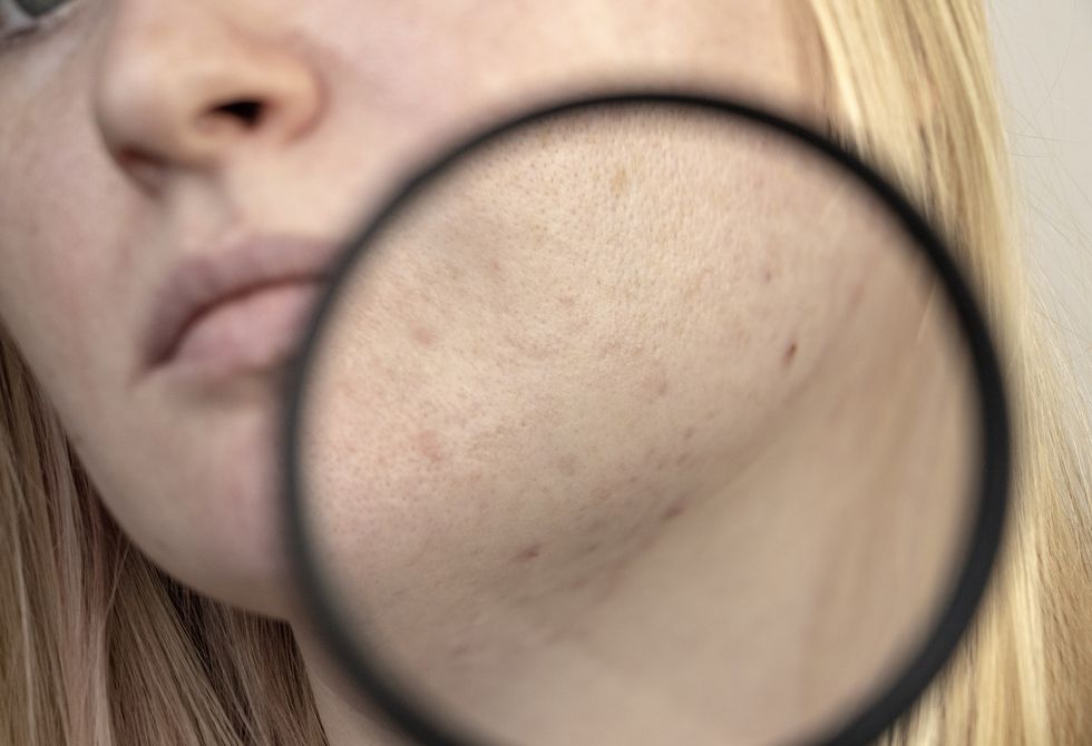 post acne under a magnifying glass skin with acne scars woman at the appointment with a dermatologist