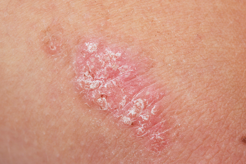 psoriasis