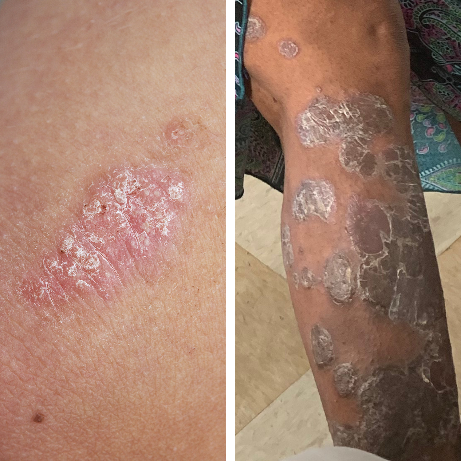 rash on skin