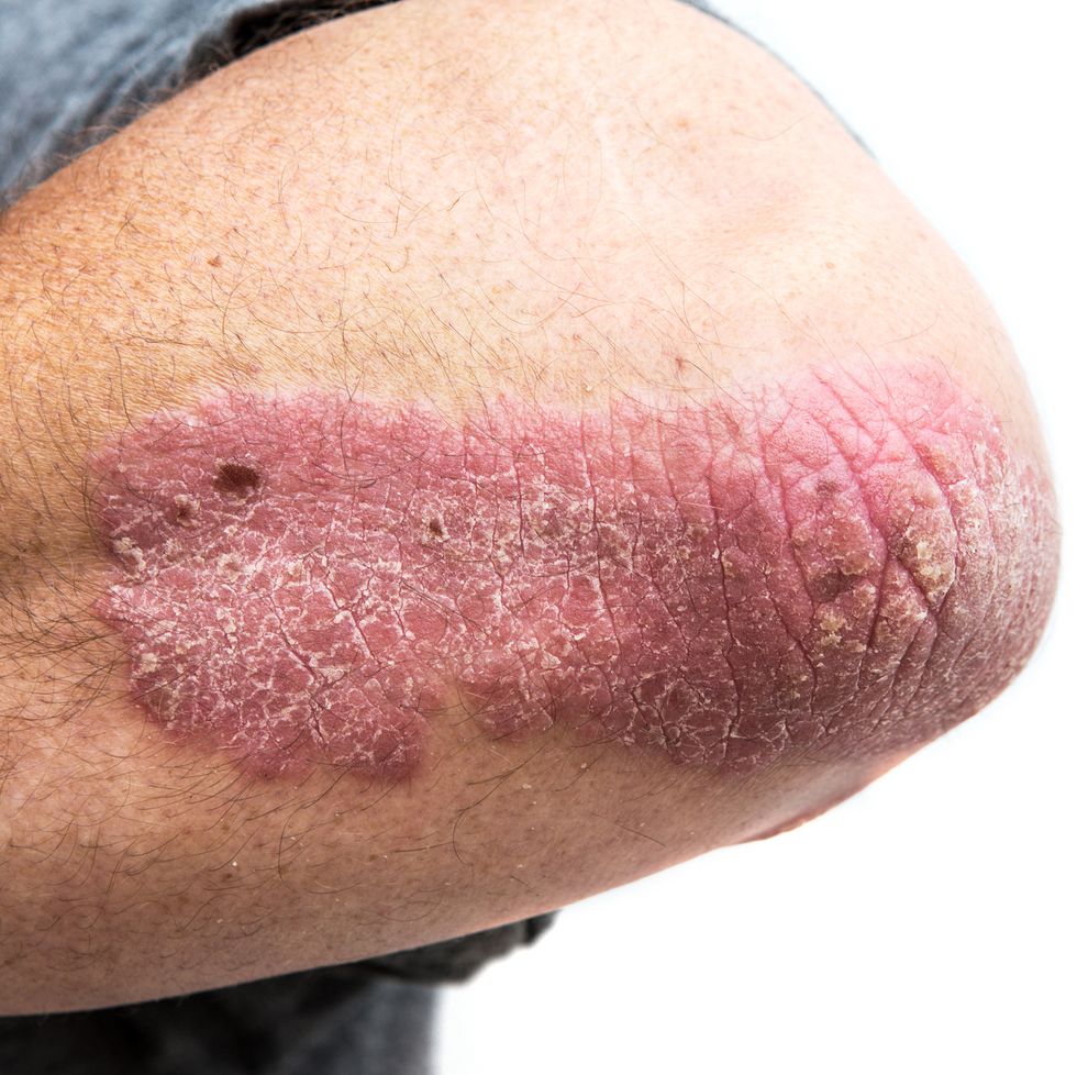 psoriasis on a mid age mans  elbow