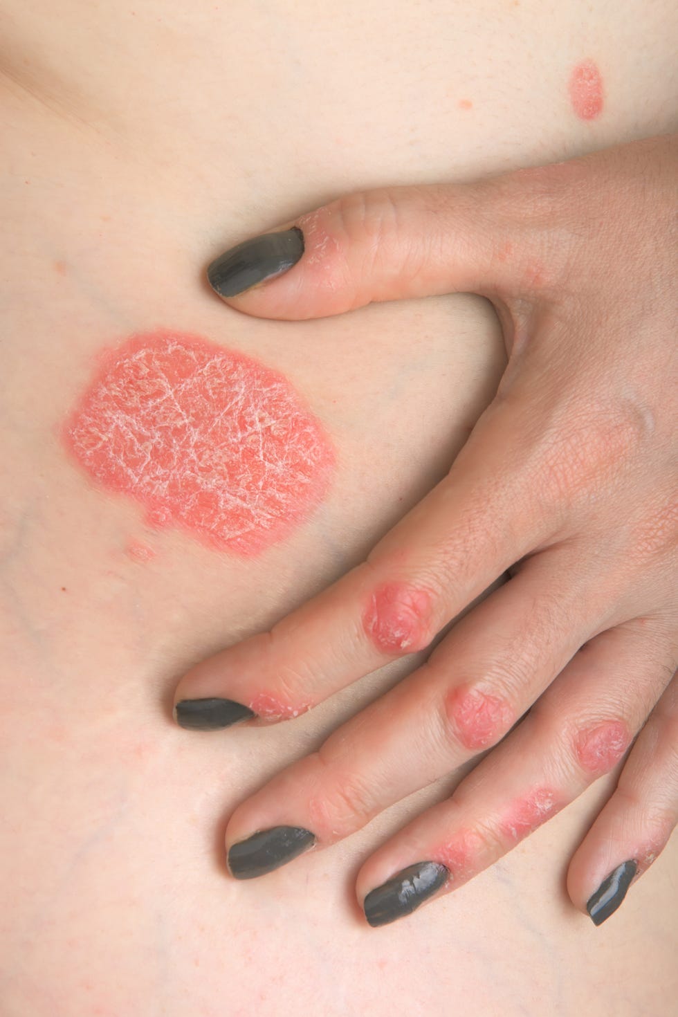 4 Skin Conditions Doctors Often Misdiagnose