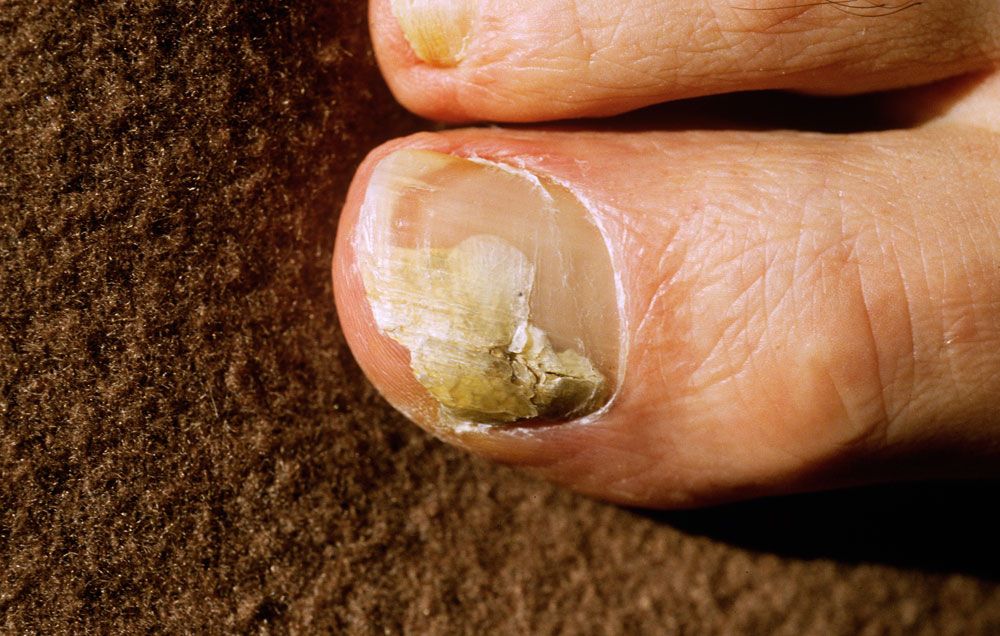 Fungal infection in the nails - top 10 natural remedies | TheHealthSite.com