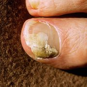 toe afflicted with fungus