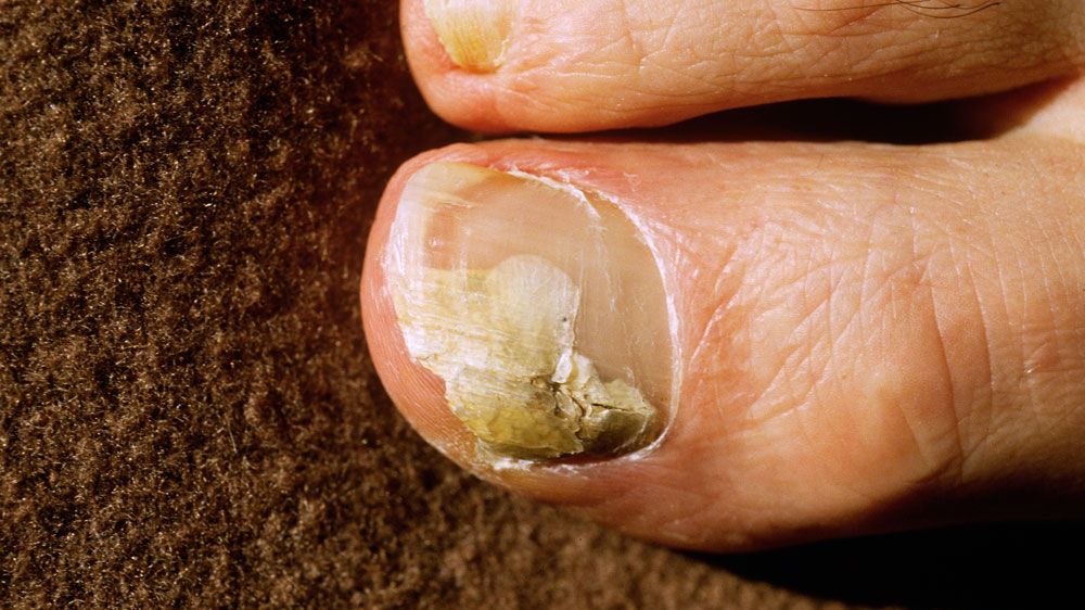 Prevention and Treatment of Toenail Fungus