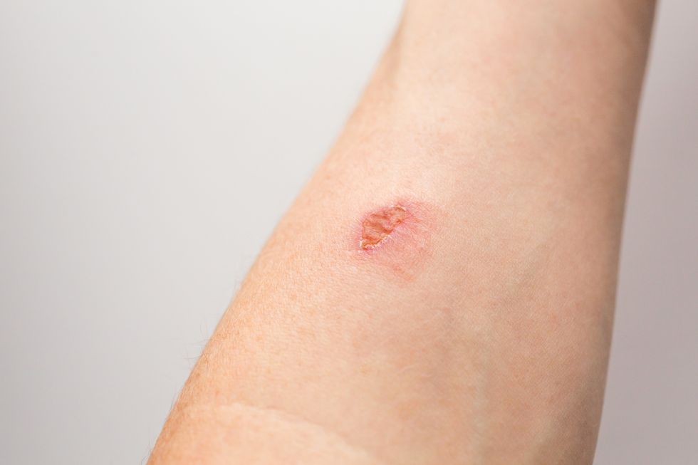 cómo tratar una quemadura en la piel