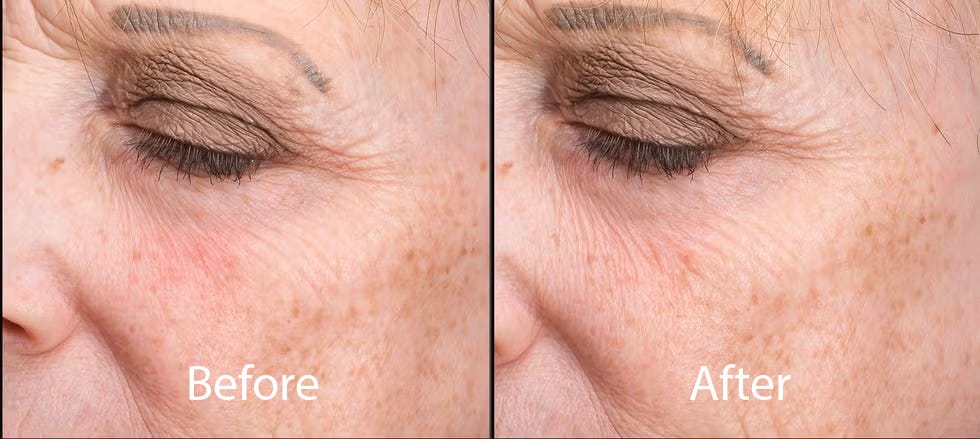 comparison of a womans eye area before and after a cosmetic treatment